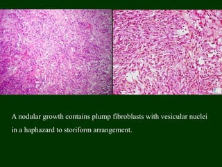 A nodular growth contains plump fibroblasts with vesicular nuclei
in a haphazard to storiform arrangement.
 