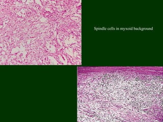 Spindle cells in myxoid background
 