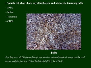 • Spindle cell shows both myofibroblastic and histiocytic immunoprofile
– SMA
– MSA
– Vimentin
– CD68
Dan Dayan et al, Clinico-pathologic correlations of myofibroblastic tumors of the oral
cavity: nodular fasciitis; J Oral Pathol Med (2005) 34: 426–35
SMA
 