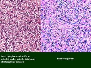 Scant cytoplasm and uniform
spindled nuclei, note the thin bands
of intercellular collagen
Storiform growth
 