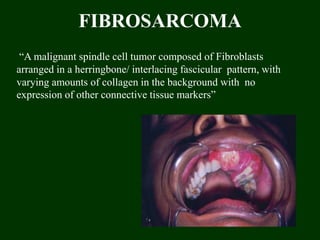FIBROSARCOMA
“A malignant spindle cell tumor composed of Fibroblasts
arranged in a herringbone/ interlacing fascicular pattern, with
varying amounts of collagen in the background with no
expression of other connective tissue markers”
 