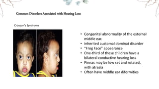 Common Disorders Associated with Hearing Loss
Crouzon's Syndrome
• Congenital abnormality of the external
middle ear.
• inherited austomal dominat disorder
• “Frog Face” appearance
• One-third of these children have a
bilateral conductive hearing loss
• Pinnas may be low set and rotated,
with atresia
• Often have middle ear diformities
 