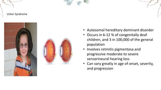 Usher Syndrome
• Autosomal hereditary dominant disorder
• Occurs in 6-12 % of congenitally deaf
children, and 3 in 100,000 of the general
population
• Involves retinitis pigmentosa and
progressive moderate to severe
sensorineural hearing loss
• Can vary greatly in age of onset, severity,
and progression
 