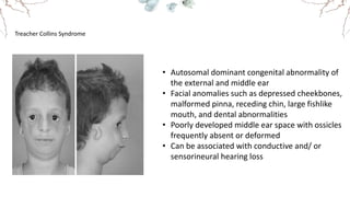 Treacher Collins Syndrome
• Autosomal dominant congenital abnormality of
the external and middle ear
• Facial anomalies such as depressed cheekbones,
malformed pinna, receding chin, large fishlike
mouth, and dental abnormalities
• Poorly developed middle ear space with ossicles
frequently absent or deformed
• Can be associated with conductive and/ or
sensorineural hearing loss
 