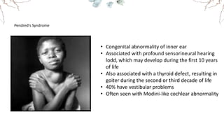 Pendred's Syndrome
• Congenital abnormality of inner ear
• Associated with profound sensorineural hearing
lodd, which may develop during the first 10 years
of life
• Also associated with a thyroid defect, resulting in
goiter during the second or third decade of life
• 40% have vestibular problems
• Often seen with Modini-like cochlear abnormality
 