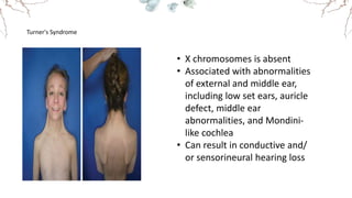 Turner's Syndrome
• X chromosomes is absent
• Associated with abnormalities
of external and middle ear,
including low set ears, auricle
defect, middle ear
abnormalities, and Mondini-
like cochlea
• Can result in conductive and/
or sensorineural hearing loss
 