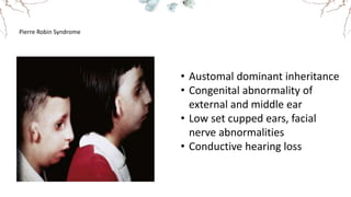 Pierre Robin Syndrome
• Austomal dominant inheritance
• Congenital abnormality of
external and middle ear
• Low set cupped ears, facial
nerve abnormalities
• Conductive hearing loss
 