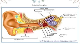 Conductive hearing loss
 