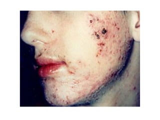 Skin Rinds Part 2 skin disorders lecture-pictures(kirin) | PPT