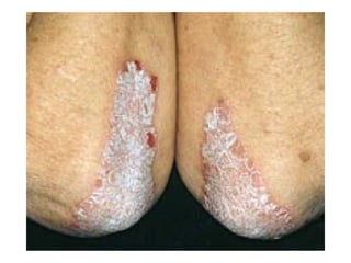 Skin Rinds Part 2 skin disorders lecture-pictures(kirin) | PPT