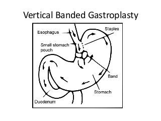 Vertical Banded Gastroplasty
 