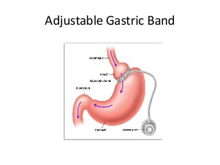 Adjustable Gastric Band
 