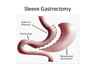 Sleeve Gastrectomy
 