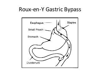 Roux-en-Y Gastric Bypass
 