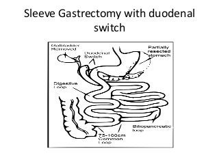 Sleeve Gastrectomy with duodenal
switch
 