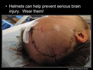 • Helmets can help prevent serious brain
injury. Wear them!
Copyright © 2010 Ryan P. Murphy
 