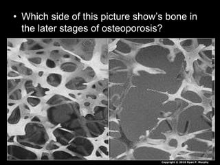 • Which side of this picture show’s bone in
the later stages of osteoporosis?
Copyright © 2010 Ryan P. Murphy
 