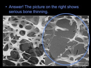 • Answer! The picture on the right shows
serious bone thinning.
Copyright © 2010 Ryan P. Murphy
 