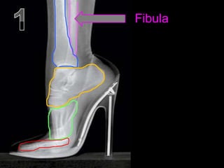 Fibula
 