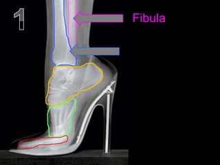 Fibula
 
