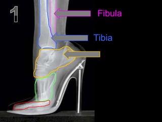 Fibula
Tibia
 