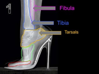 Fibula
Tibia
Tarsals
 