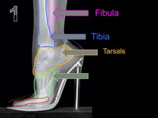 Fibula
Tibia
Tarsals
 