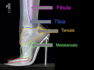 Fibula
Tibia
Tarsals
Metatarsals
 