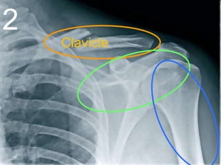 2
Clavicle
 