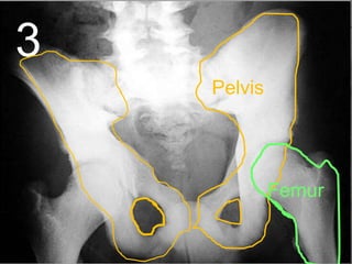 3
Pelvis
Femur
 