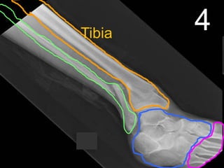 4Tibia
 