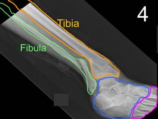 4Tibia
Fibula
 
