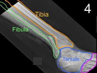 4Tibia
Fibula
Tarsals
 