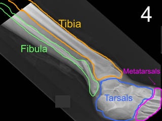 4Tibia
Fibula
Tarsals
Metatarsals
 