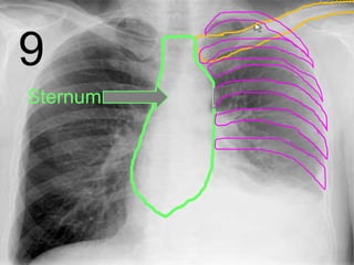 9
Sternum
 