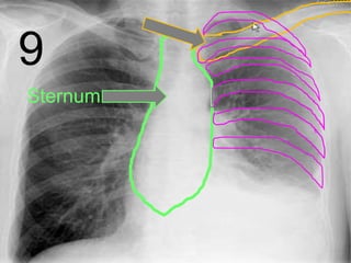 9
Sternum
 