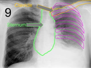 9
Sternum
Clavicle
 