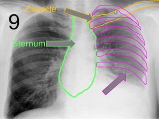 9
Sternum
Clavicle
 