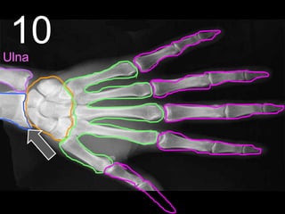 10Ulna
 