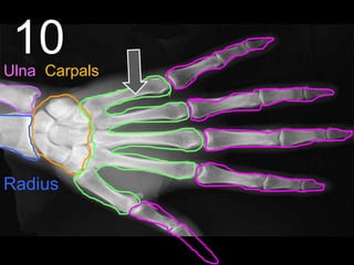 10
Radius
Ulna Carpals
 