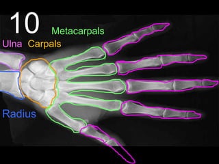 10
Radius
Ulna Carpals
Metacarpals
 