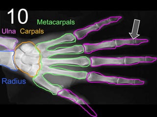10
Radius
Ulna Carpals
Metacarpals
 