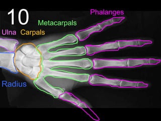 10
Radius
Ulna Carpals
Metacarpals
Phalanges
 