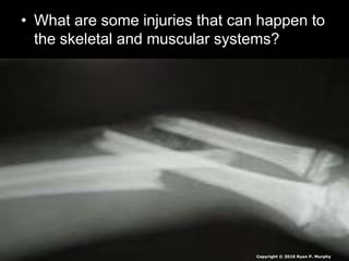 • What are some injuries that can happen to
the skeletal and muscular systems?
Copyright © 2010 Ryan P. Murphy
 