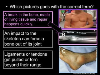 • Which pictures goes with the correct term?
A
B
C
A break in the bone, made
of living tissue and repair
happens quickly.
An impact to the
skeleton can force a
bone out of its joint
Ligaments or tendons
get pulled or torn
beyond their range
Copyright © 2010 Ryan P. Murphy
 