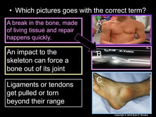 • Which pictures goes with the correct term?
A
B
C
A break in the bone, made
of living tissue and repair
happens quickly.
An impact to the
skeleton can force a
bone out of its joint
Ligaments or tendons
get pulled or torn
beyond their range
Copyright © 2010 Ryan P. Murphy
 