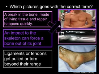 • Which pictures goes with the correct term?
A
B
C
A break in the bone, made
of living tissue and repair
happens quickly.
An impact to the
skeleton can force a
bone out of its joint
Ligaments or tendons
get pulled or torn
beyond their range
Copyright © 2010 Ryan P. Murphy
 