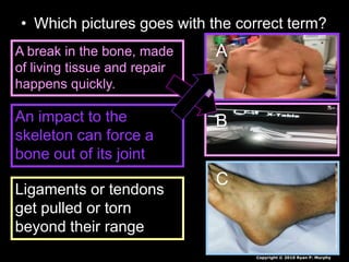 • Which pictures goes with the correct term?
A
B
C
A break in the bone, made
of living tissue and repair
happens quickly.
An impact to the
skeleton can force a
bone out of its joint
Ligaments or tendons
get pulled or torn
beyond their range
Copyright © 2010 Ryan P. Murphy
 