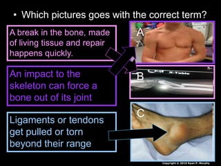 • Which pictures goes with the correct term?
A
B
C
A break in the bone, made
of living tissue and repair
happens quickly.
An impact to the
skeleton can force a
bone out of its joint
Ligaments or tendons
get pulled or torn
beyond their range
Copyright © 2010 Ryan P. Murphy
 