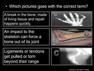• Which pictures goes with the correct term?
A break in the bone, made
of living tissue and repair
happens quickly.
An impact to the
skeleton can force a
bone out of its joint
Ligaments or tendons
get pulled or torn
beyond their range
Copyright © 2010 Ryan P. Murphy
 